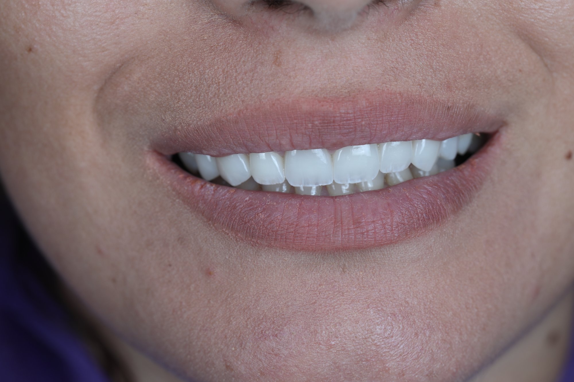 Pas trajtimit - rezultat dentar Hollywood Smile - DentalKosova Prizren Kosovo