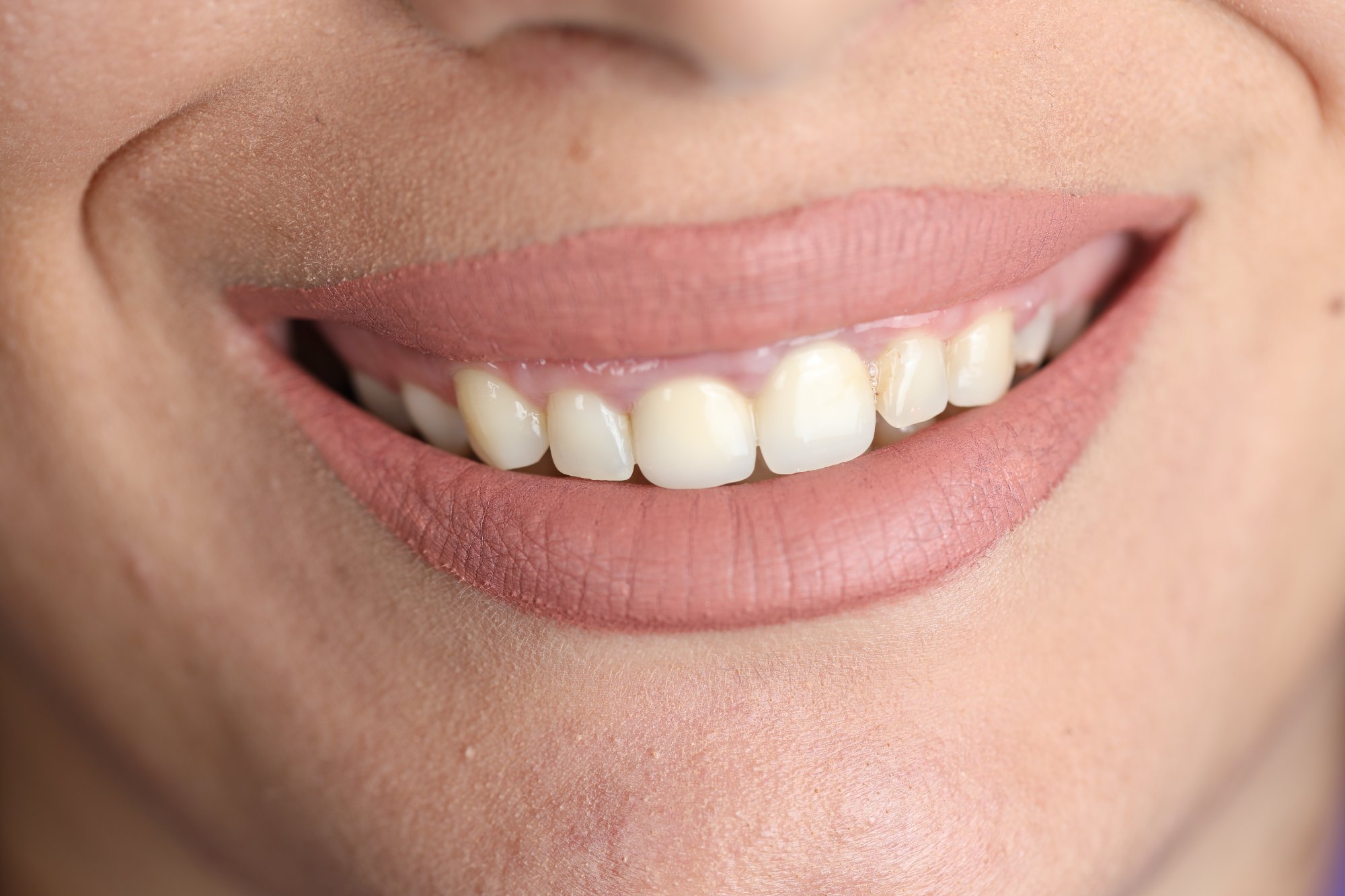 Para trajtimit - transformim dhembesh - DentalKosova Prizren Kosovo